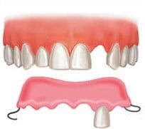 A picture demonstrating Royal Jubilee Denture Clinic's acrylic partial denture service