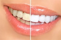 Picture of Teeth Whitening denture services in Victoria BC, at RJDC.